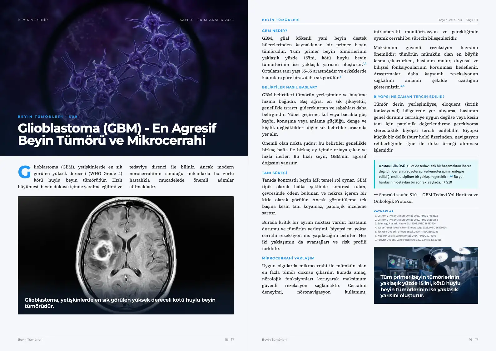 Beyin ve Sinir Sayı 01 — Glioblastoma (GBM) - En Agresif Beyin Tümörü ve Mikrocerrahi · s. 16–17