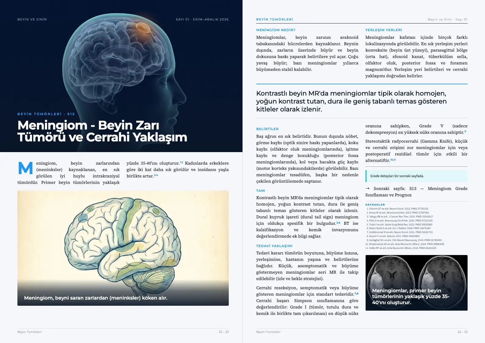 Beyin ve Sinir Sayı 01 — Meningiom - Beyin Zarı Tümörü ve Cerrahi Yaklaşım · s. 22–23