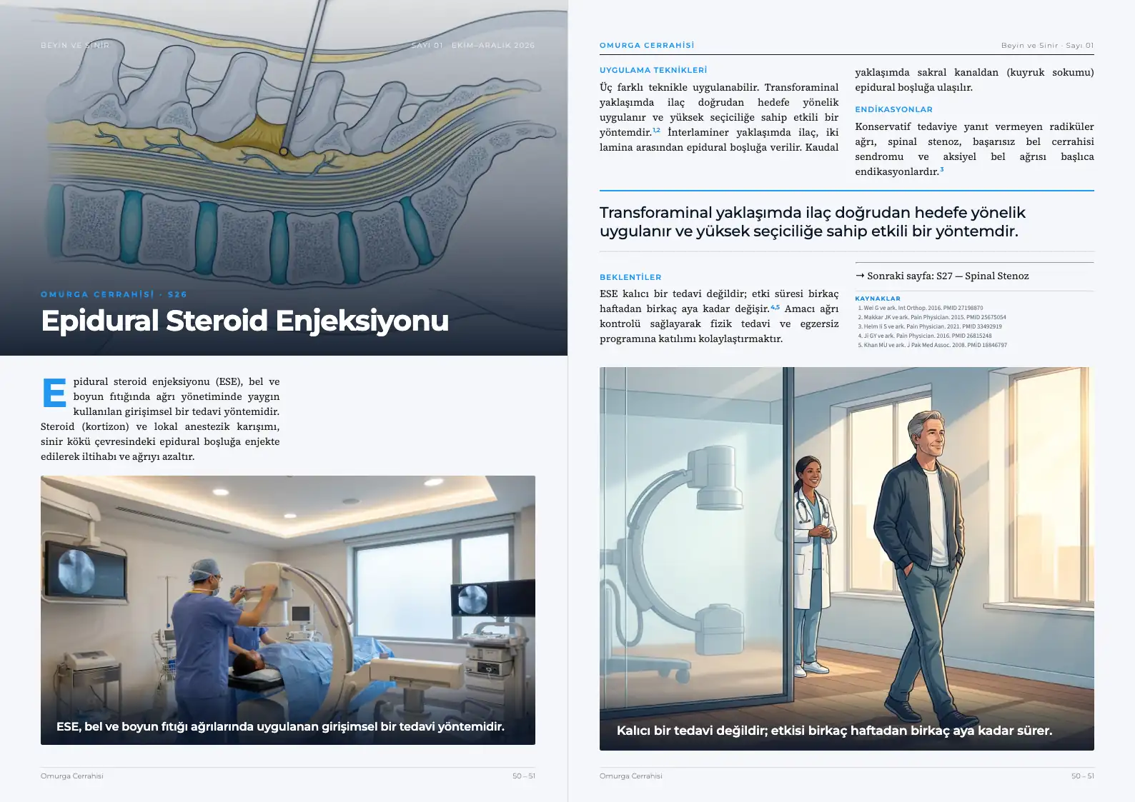 Beyin ve Sinir Sayı 01 — Epidural Steroid Enjeksiyonu · s. 50–51