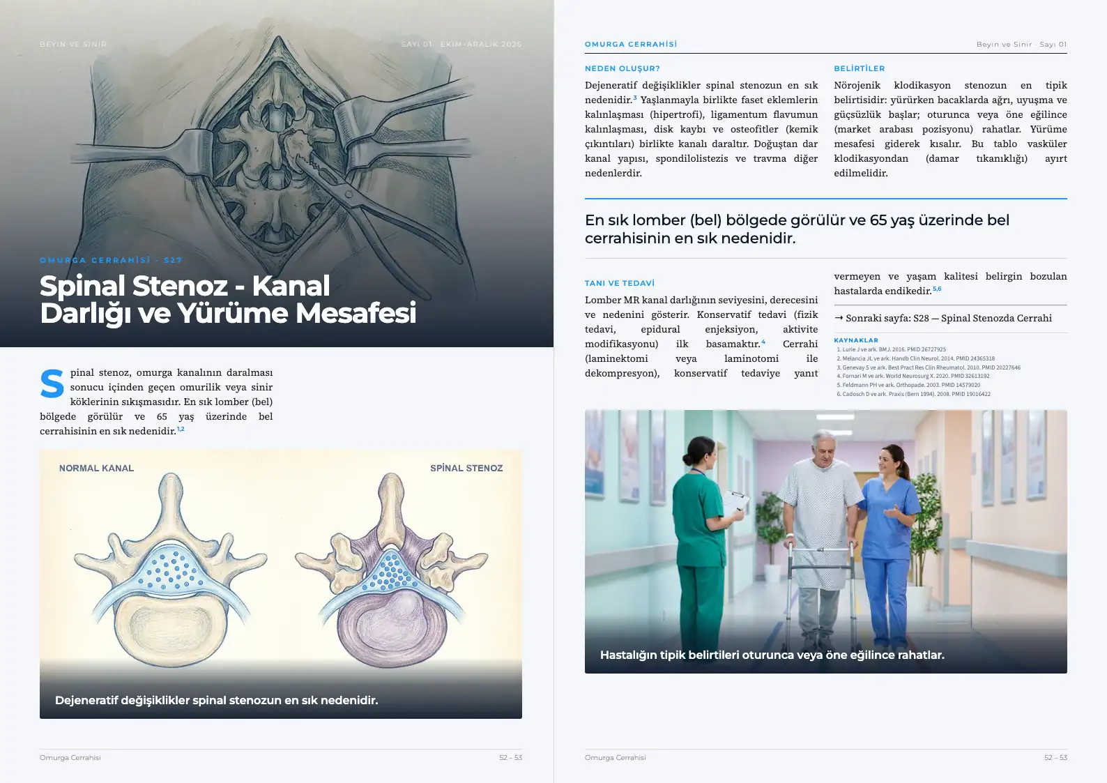 Beyin ve Sinir Sayı 01 — Spinal Stenoz - Kanal Darlığı ve Yürüme Mesafesi · s. 52–53