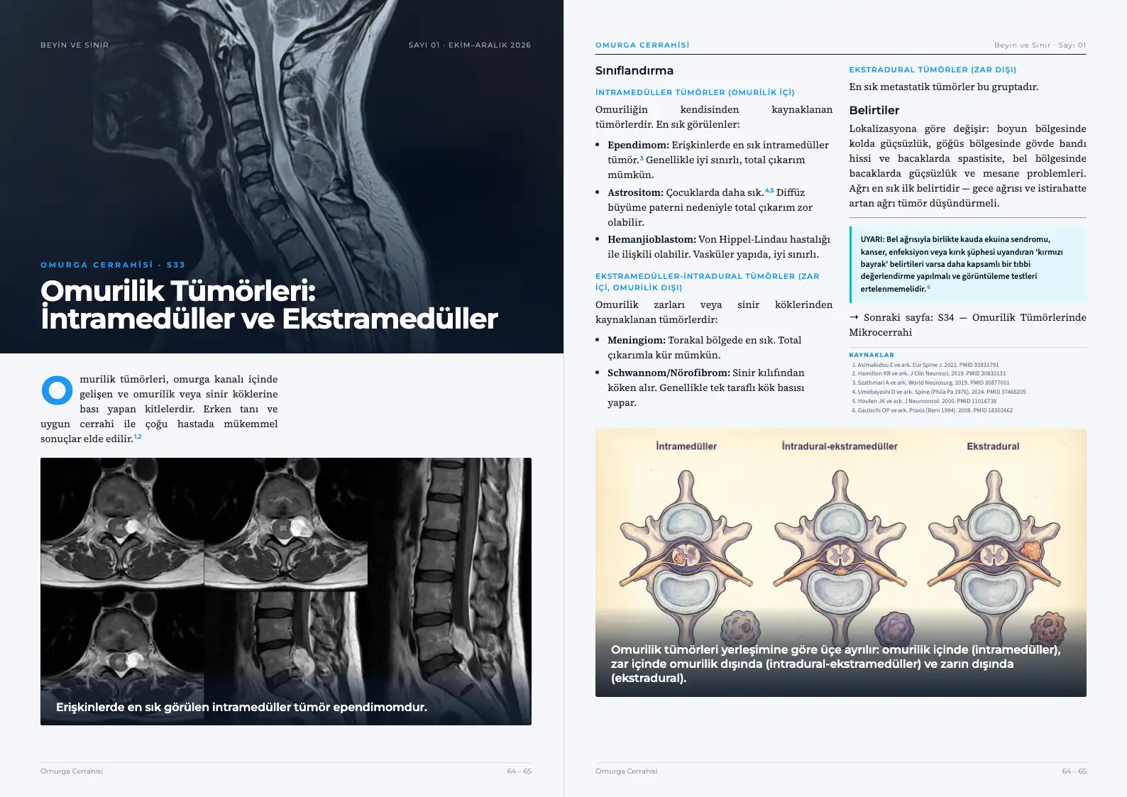 Beyin ve Sinir Sayı 01 — Omurilik Tümörleri: İntramedüller ve Ekstramedüller · s. 64–65