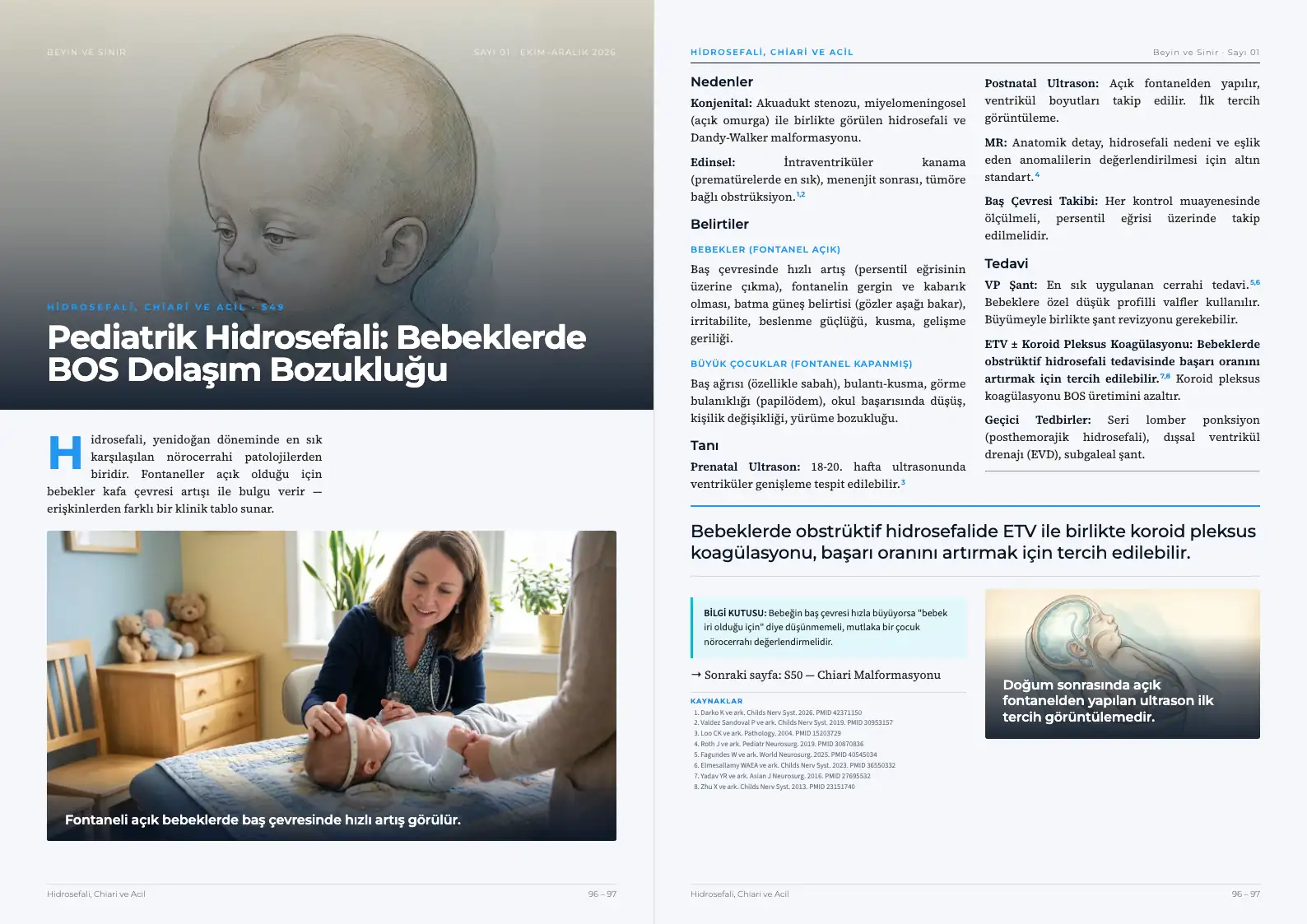 Beyin ve Sinir Sayı 01 — Pediatrik Hidrosefali: Bebeklerde BOS Dolaşım Bozukluğu · s. 96–97