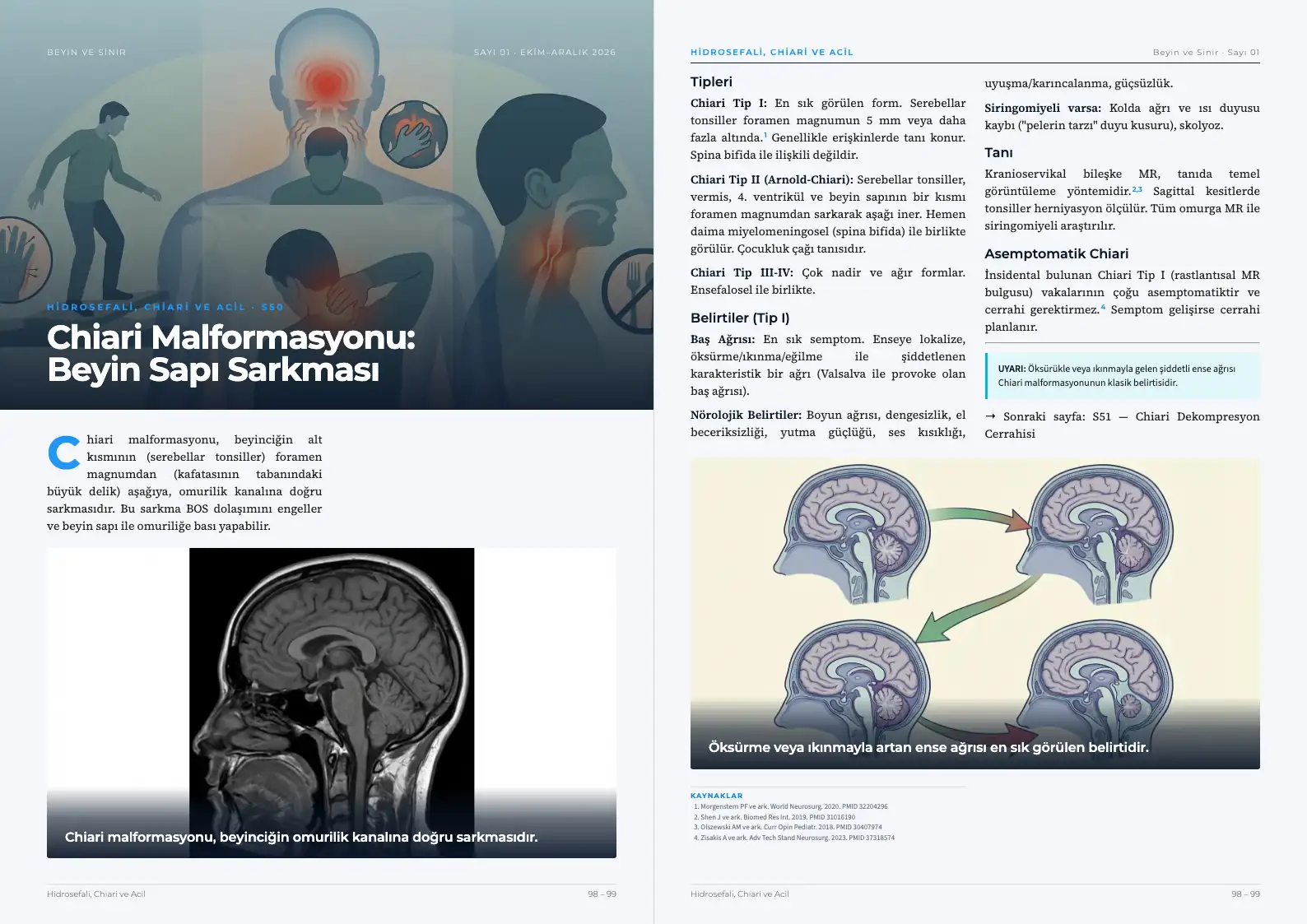 Beyin ve Sinir Sayı 01 — Chiari Malformasyonu: Beyin Sapı Sarkması · s. 98–99